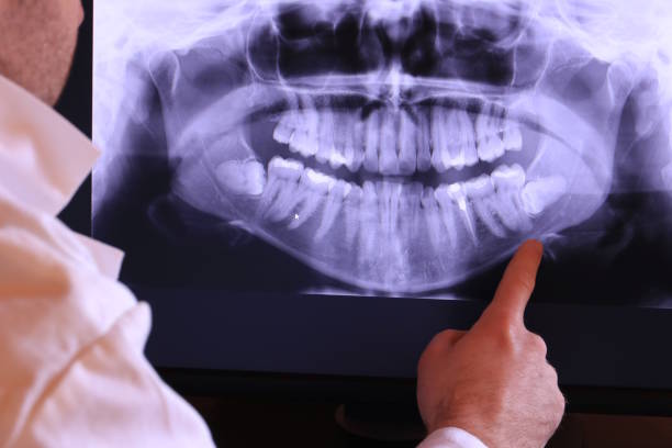 Best Emergency Dentist for Lost Fillings or Crowns in Mount Jackson, VA